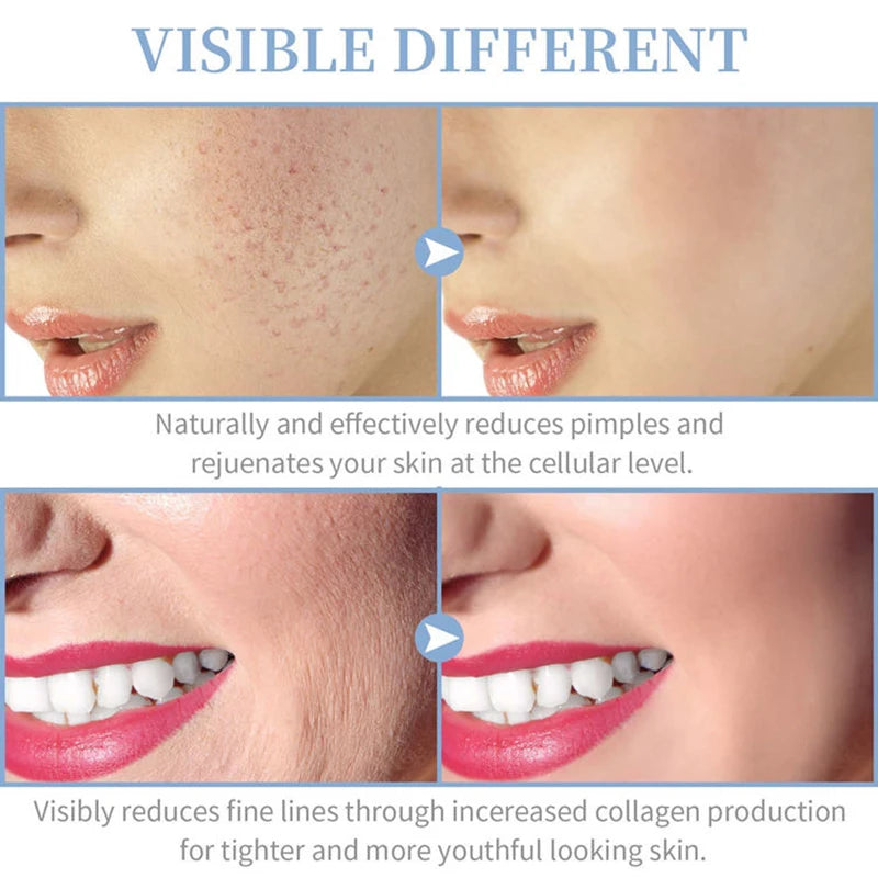 High Frequency Skin Therapy Wand – Portable Facial Device for Skin Tightening & Acne Treatment
